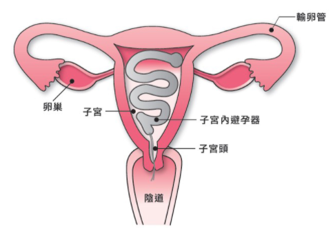  避孕方法-子宮內避孕器